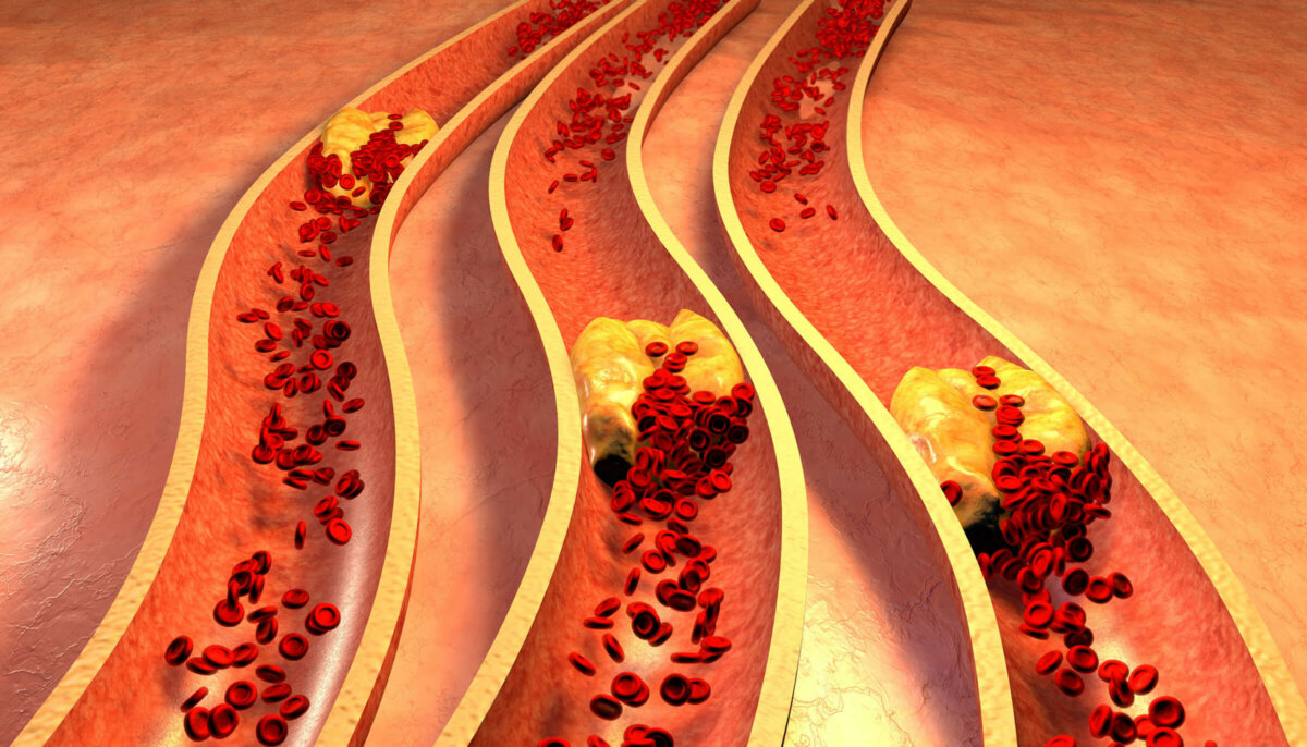 Cholesterol: Going Deeper than the Numbers